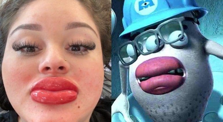 Mulher fica com bocão após procedimento e se compara a personagem de 'Monstros S.A.' Mulher fica com bocão após procedimento e se compara a personagem de 'Monstros S.A.'
