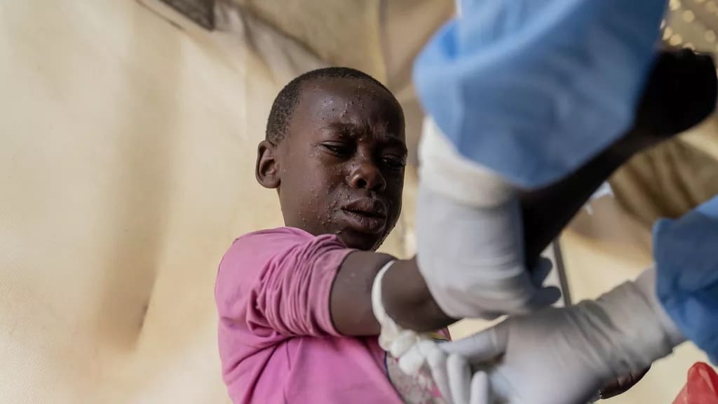 África tem quase 4.000 novos casos de Mpox em uma semana