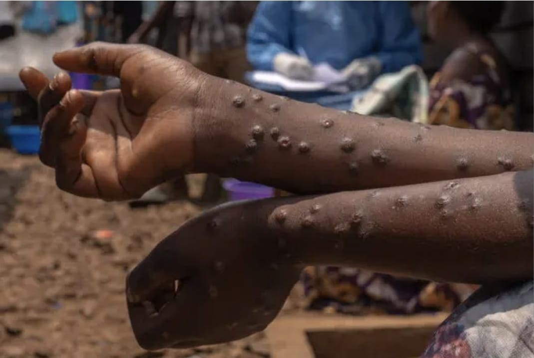 Aumentam casos do Mpox na província do Niassa      