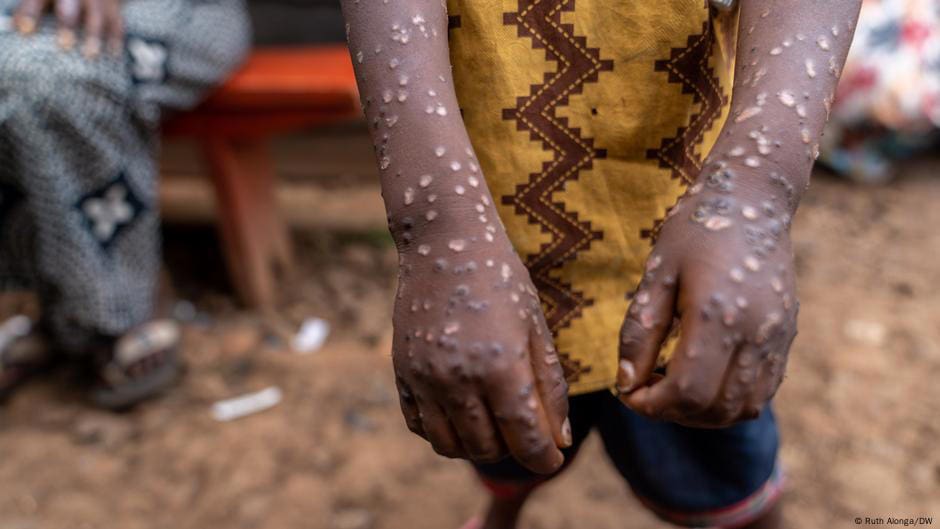 MINISTÉRIO DA SAÚDE CONFIMA A DETECÇÃO DE CASOS DE MPOX "VARÍOLA DOS MACACOS" NA PROVÍNCIA DE NIASSA